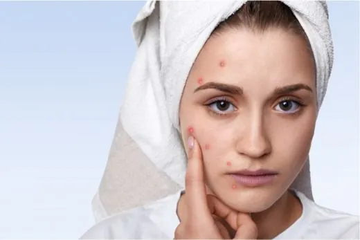 Acne & Pimples