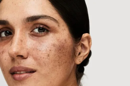 Pigmentation & Dark Spots