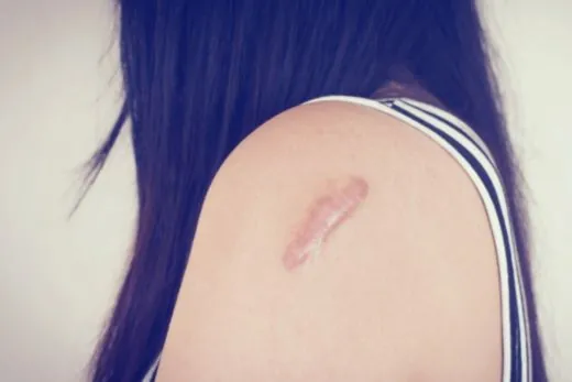 Stretch Marks & Scars